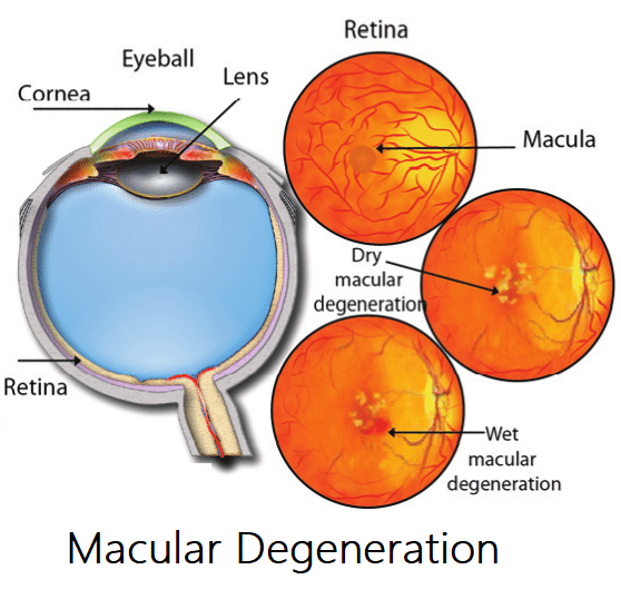 age related macular degeneration