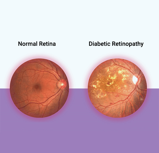 diabetic-retinopathy-560x538