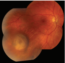Intraocular Melanoma Causes and Treatment