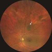 Choroidal Nevus : Symptoms