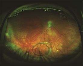 Intraocular Lens Dislocation